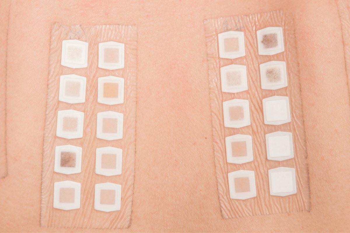 patch test pomaga zidentyfikować substancje wywołujące alergię kontaktową skóry test skórny wykrywający uczulenie na substancje kontaktowe