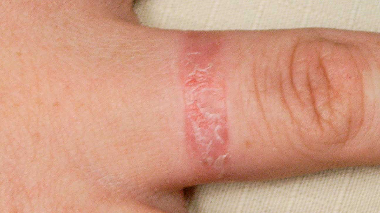lekarz nakładający plaster z lateksem na ramię pacjenta podczas testu alergicznego