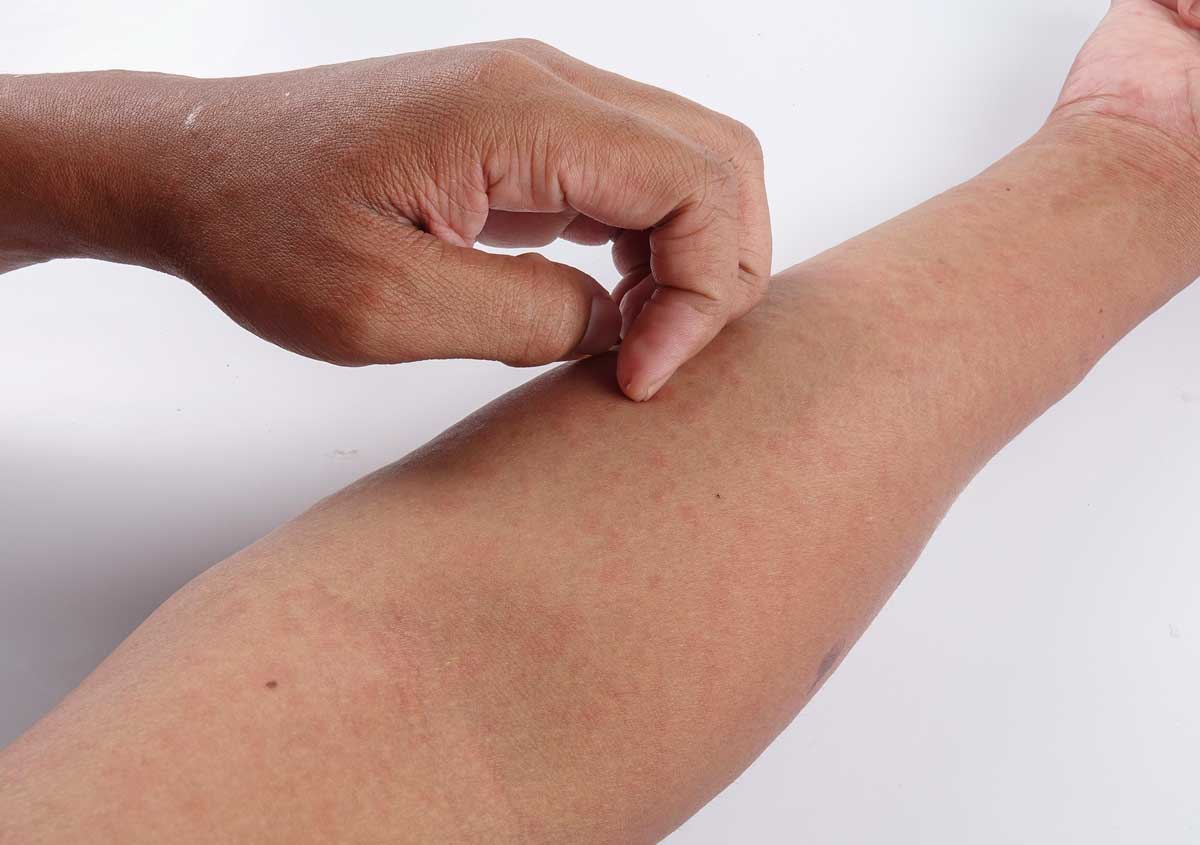 Wysypka jako skutek uboczny antybiotyku czerwone plamy po antybiotyku objaw reakcji alergicznej