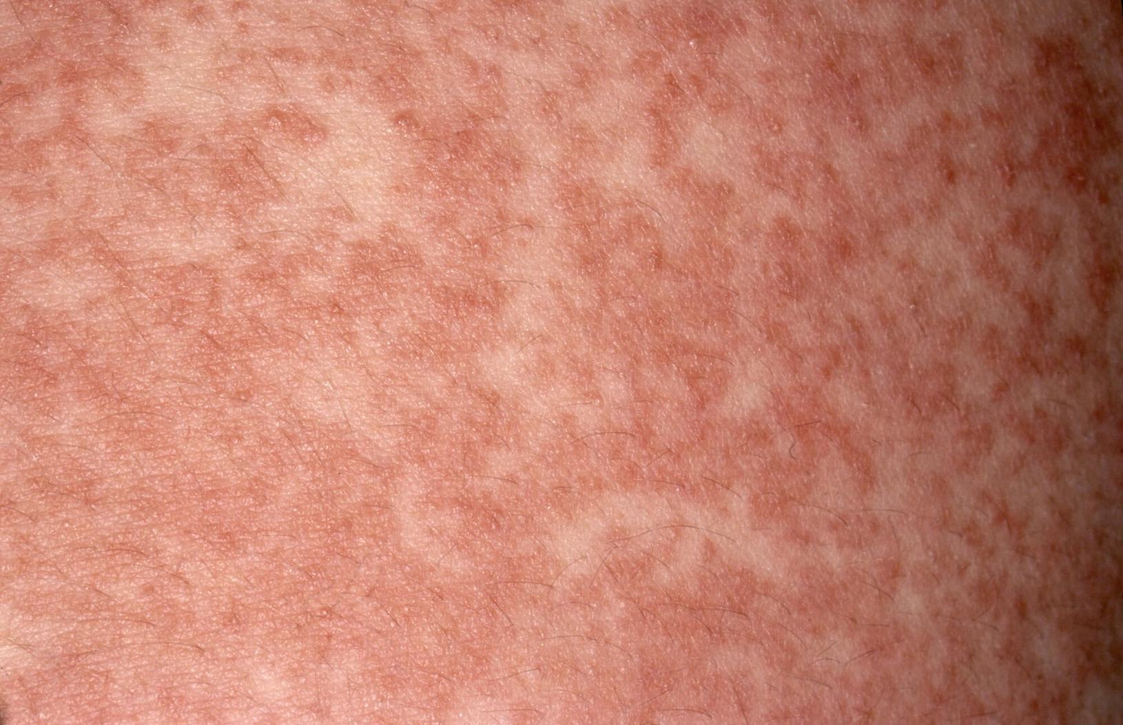 Konsultacja alergologiczna w przypadku podejrzenia uczulenia diagnoza alergii na antybiotyki u lekarza badanie