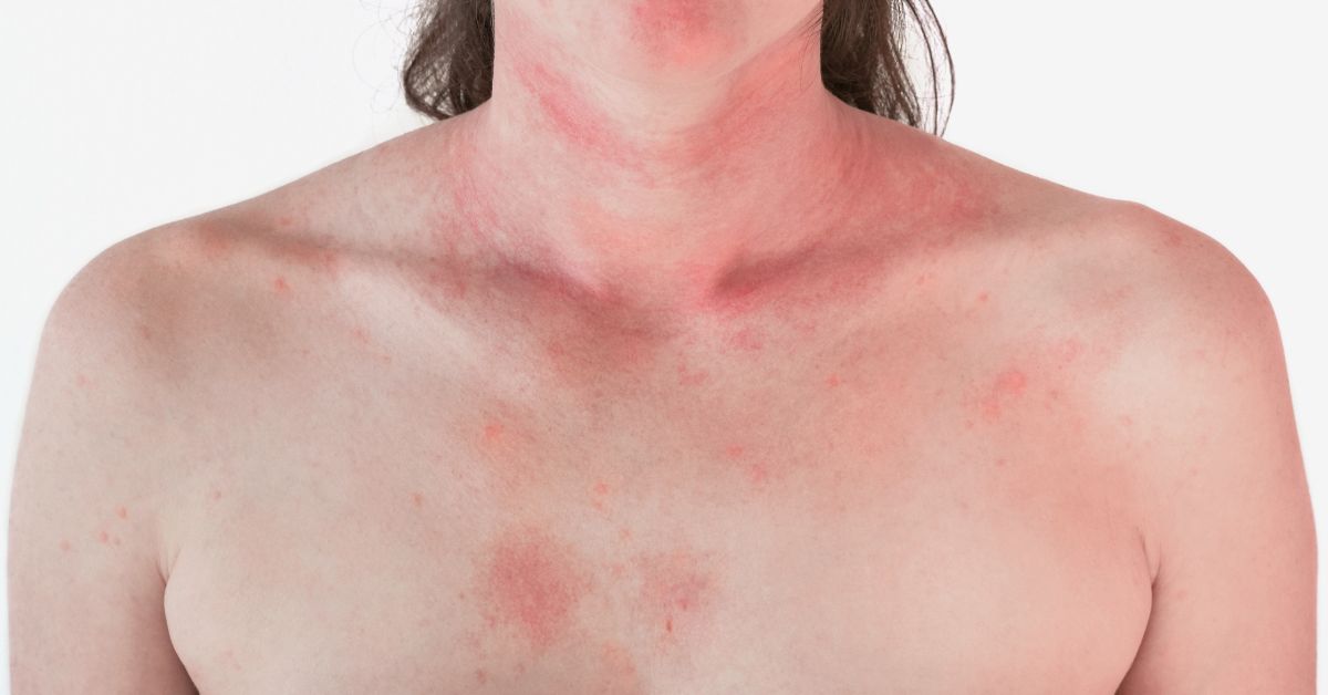 Nietolerancja histaminy – alergia czy zaburzenie DAO? Objawy i badania
